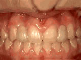 Missing Lateral Incisors - After