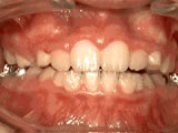 Phase 1 Dental Treatment - After