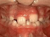 Phase 1 Dental Treatment - Before