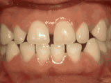 Spacing Of Teeth - Before